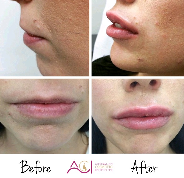 Courtney Wright Lips Before and After bmp